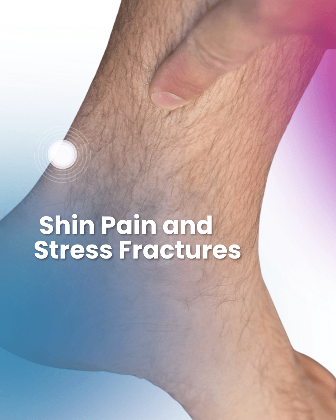 shin pain from running along the tibia showing common stress fracture location